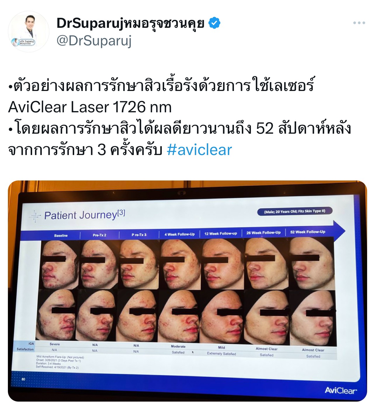 Update เครื่องเลเซอร์สำหรับรักษาสิวโดยเฉพาะ จับกับต่อมไขมันโดยตรง = AviClear 1726 nm Laser Update เครื่องเลเซอร์สำหรับรักษาสิวโดยเฉพาะ จับกับต่อมไขมันโดยตรง = AviClear 1726 nm Laser