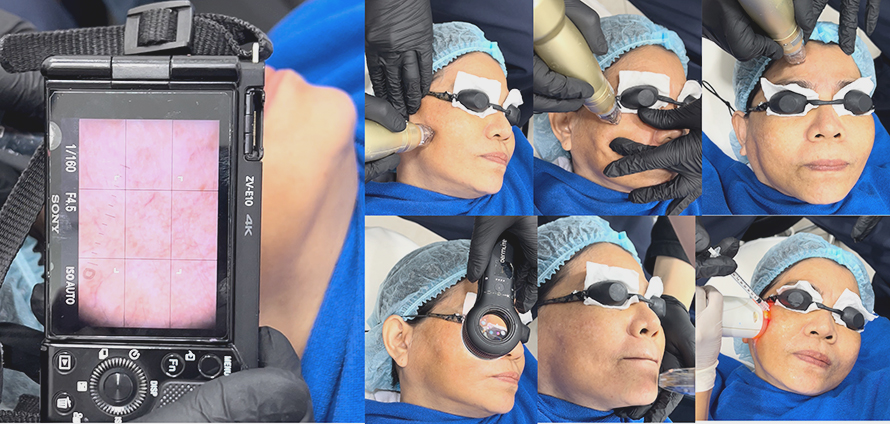 รักษาฝ้า ด้วยการฟื้นฟูผิวด้วยการใช้ เข็มพลังงานคลื่นวิทยุโปรแกรม SylfirmX Plus + โปรแกรม Exosomes (Program SylfirmX Plus Fractional RF MicroNeedle + Program Exosomes for Melasma Skin Rehabilitation) รักษาฝ้า ด้วยการฟื้นฟูผิวด้วยการใช้ เข็มพลังงานคลื่นวิทยุโปรแกรม SylfirmX Plus + โปรแกรม Exosomes (Program SylfirmX Plus Fractional RF MicroNeedle + Program Exosomes for Melasma Skin Rehabilitation)