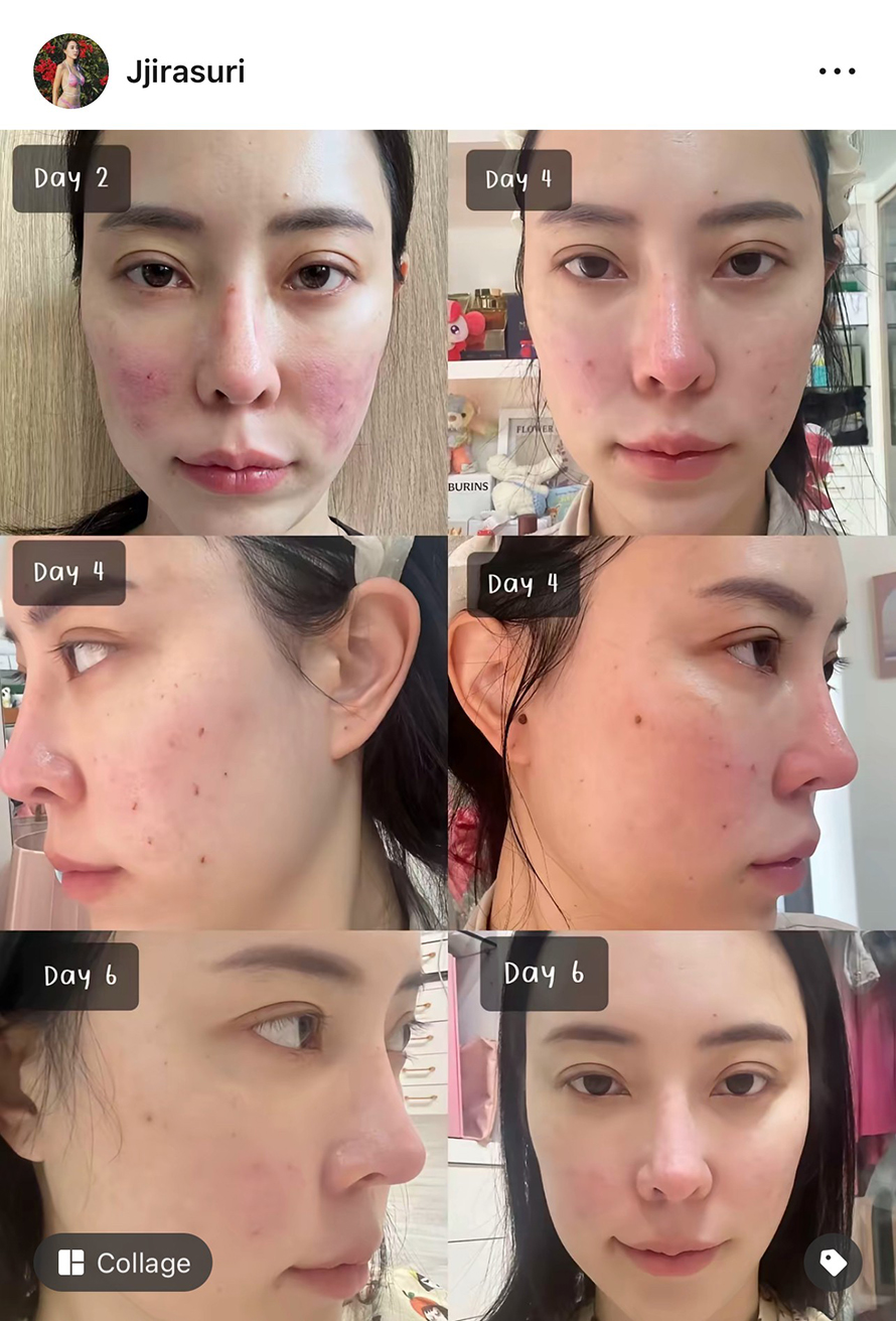 วันนี้คุณหมอแนะนำให้ยิงตัว โปรแรกม SylfirmX plus หลังจากที่เรายิงโปรแกรม Pico มาหลายรอบหลายหัว 555 ของใหม่แบบนี้คุณหมอว่าดี หนูก็เอาค่ะ วันนี้คุณหมอแนะนำให้ยิงตัว โปรแรกม SylfirmX plus หลังจากที่เรายิงโปรแกรม Pico มาหลายรอบหลายหัว 555 ของใหม่แบบนี้คุณหมอว่าดี หนูก็เอาค่ะ