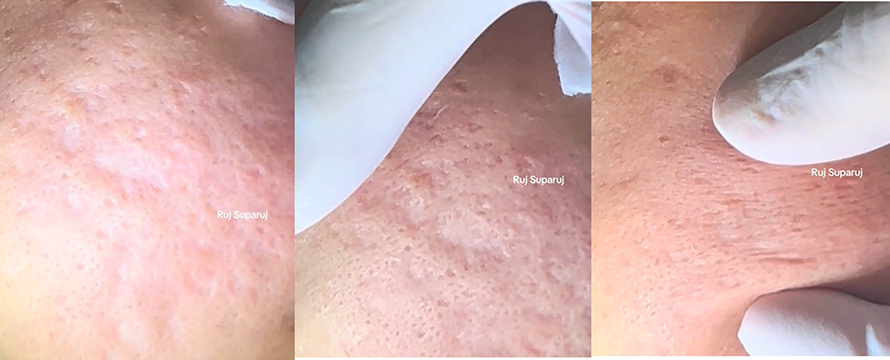 หลุมสิวลึกที่มีพังผืดสีขาว (Fibrosis/ Fibrotic white scar) สาเหตุและการดูแลรักษา
