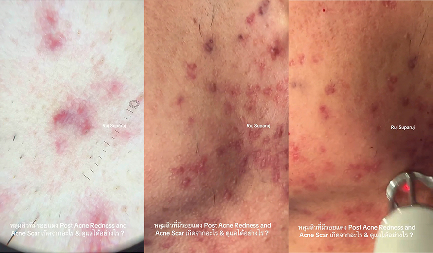 หลุมสิวที่มีรอยแดง Post Acne Redness and Acne Scar เกิดจากอะไร & ดูแลได้อย่างไร ? หลุมสิวที่มีรอยแดง Post Acne Redness and Acne Scar เกิดจากอะไร & ดูแลได้อย่างไร ?