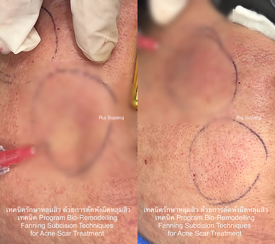 การทำงานของ Program Profhilo