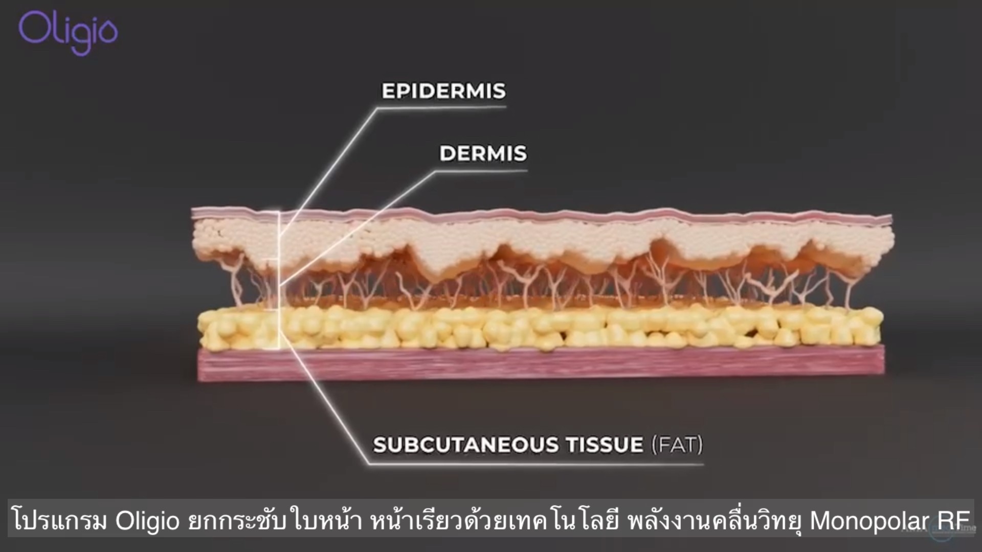 ยกกระชับผิวหน้าด้วย โปรแกรม Oligio Monopolar RF มีกลไก& จุดเด่น อย่างไร ?