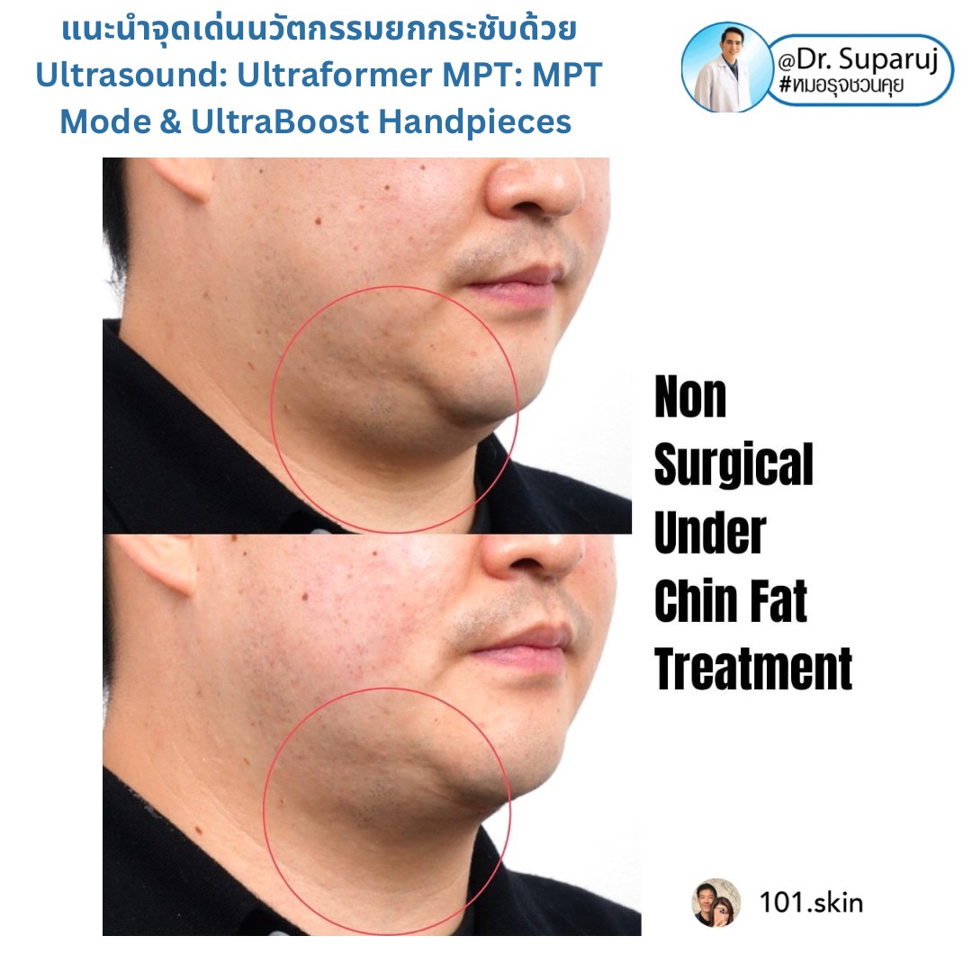 แนะนำนวัตกรรม พลังงานเครื่องเสียง Macro & Micro Focused Ultrasound ยกกระชับผิว Ultraformer MPT: จุดเด่น + ทดสอบลักษณะพลังงาน + การประเมินลักษณะผิว ให้เห็นกันชัดๆเลยครับ แนะนำนวัตกรรม พลังงานเครื่องเสียง Macro & Micro Focused Ultrasound ยกกระชับผิว Ultraformer MPT: จุดเด่น + ทดสอบลักษณะพลังงาน + การประเมินลักษณะผิว ให้เห็นกันชัดๆเลยครับ