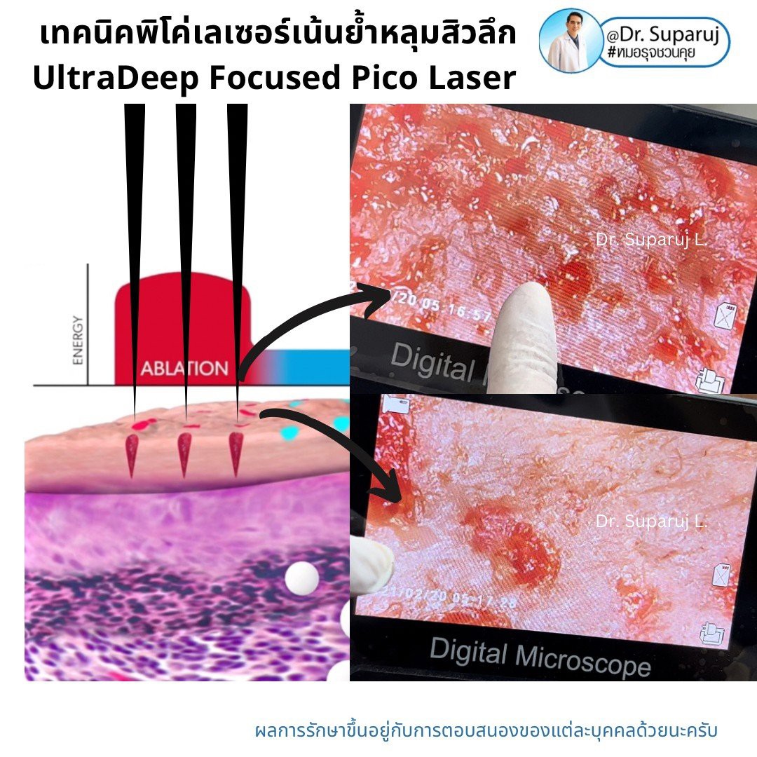 Update เทคนิครักษาหลุมสิว: หลุมสิวแบบจิกลึก Ice Pick Acne Scar มีลักษณะ & ดูแลได้อย่างไร ? Update เทคนิครักษาหลุมสิว: หลุมสิวแบบจิกลึก Ice Pick Acne Scar มีลักษณะ & ดูแลได้อย่างไร ?