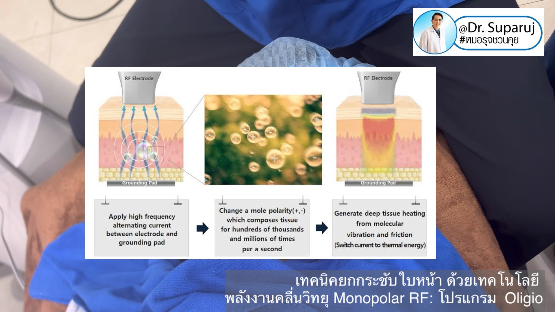 คำถามยอดฮิต นวัตกรรมกระชับผิวโปรแกรม Oligio