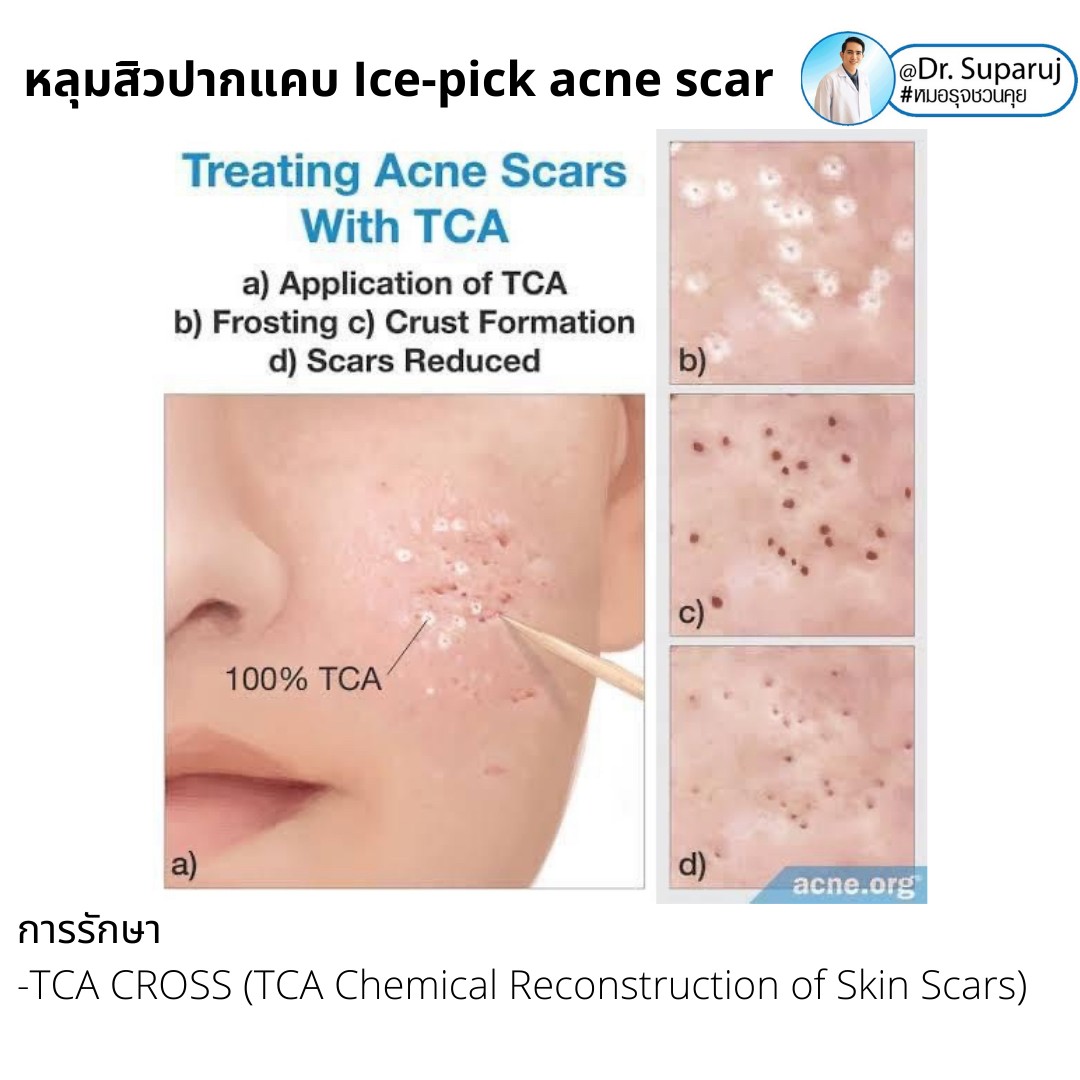 แนะนำเทคนิครักษาหลุมสิวจิกลึก Ice Pick Acne Scar ด้วยเทคนิคเลเซอร์ UltraDeep Pico Technique (Ice Pick Acne Scar Treatment with Discovery Pico Laser + UltraDeep Pico Technique)  แนะนำเทคนิครักษาหลุมสิวจิกลึก Ice Pick Acne Scar ด้วยเทคนิคเลเซอร์ UltraDeep Pico Technique (Ice Pick Acne Scar Treatment with Discovery Pico Laser + UltraDeep Pico Technique)