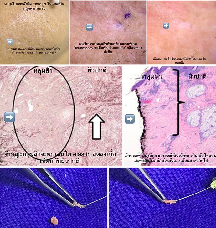 Update เทคนิค Subcision ตัดพังผืดรักษาหลุมสิว Acne Scar Subcision Techniques Update เทคนิค Subcision ตัดพังผืดรักษาหลุมสิว Acne Scar Subcision Techniques