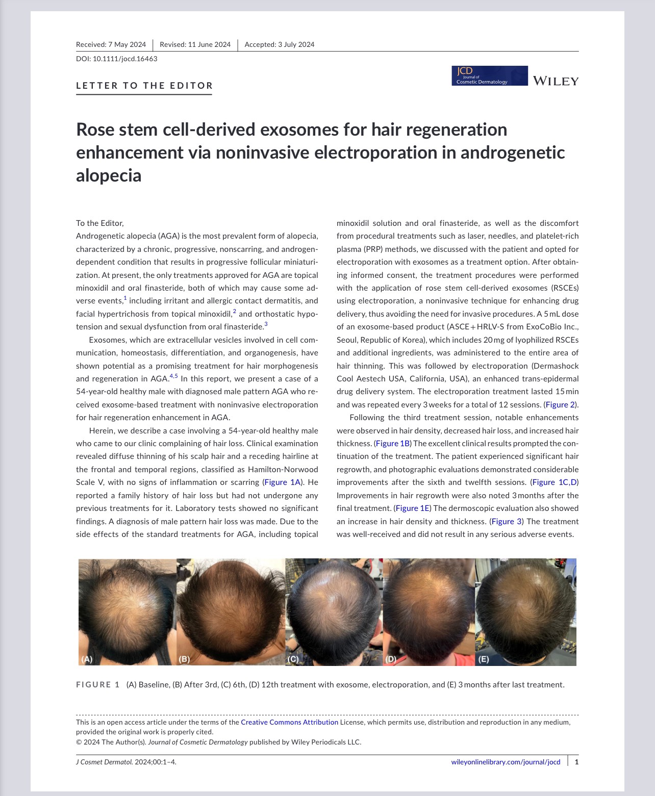 งานวิจัยล่าสุดโดย ผศ. นพ. ศุภะรุจ เลื่องอรุณ (หมอรุจ) และ รศ. นพ. เทอดพงศ์ เต็มภาคย์ ที่ตีพิมพ์ใน Journal of Cosmetic Dermatology ศึกษาการใช้เอ็กโซโซมที่ได้จากเซลล์ต้นกำเนิดของดอกกุหลาบเพื่อเสริมการฟื้นฟูเส้นผมโดยการใช้อิเล็กโทรโพเรชั่นในผู้ป่วยที่มีภาวะ ผมบางจากพันธุกรรม AGA***โดยไม่ใช้ยา การฉีด เลเซอร์ หรือ RF***ครับ งานวิจัยล่าสุดโดย ผศ. นพ. ศุภะรุจ เลื่องอรุณ (หมอรุจ) และ รศ. นพ. เทอดพงศ์ เต็มภาคย์ ที่ตีพิมพ์ใน Journal of Cosmetic Dermatology ศึกษาการใช้เอ็กโซโซมที่ได้จากเซลล์ต้นกำเนิดของดอกกุหลาบเพื่อเสริมการฟื้นฟูเส้นผมโดยการใช้อิเล็กโทรโพเรชั่นในผู้ป่วยที่มีภาวะ ผมบางจากพันธุกรรม AGA***โดยไม่ใช้ยา การฉีด เลเซอร์ หรือ RF***ครับ