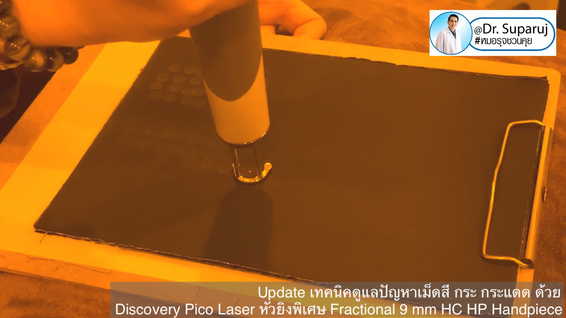 แนะนำเทคนิคดูแลปานน้ำตาล ด้วยเลเซอร์เทคนิค Fractional Pigment Toning FPT Discovery Picosecond Laser + Fractional 9 mm HC HP Handpiece
