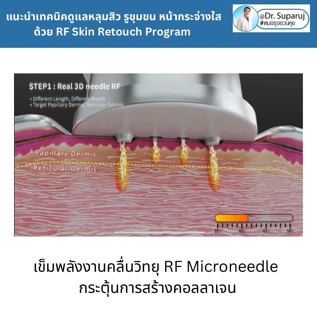 แนะนำเทคนิคดูแลหลุมสิว รูขุมขน หน้ากระจ่างใสด้วย RF Skin Retouch Program