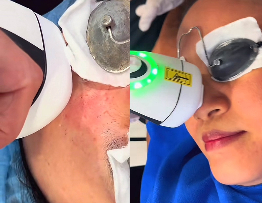 หลุมสิวที่มีรอยแดง Post Acne Redness and Acne Scar เกิดจากอะไร & ดูแลได้อย่างไร ?