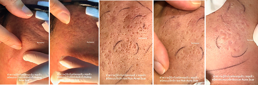 ทำความรู้จักชนิดหลุมสิว: Rolling, Boxcar และ Ice Pick Acne Scar ทำความรู้จักชนิดหลุมสิว: Rolling, Boxcar และ Ice Pick Acne Scar