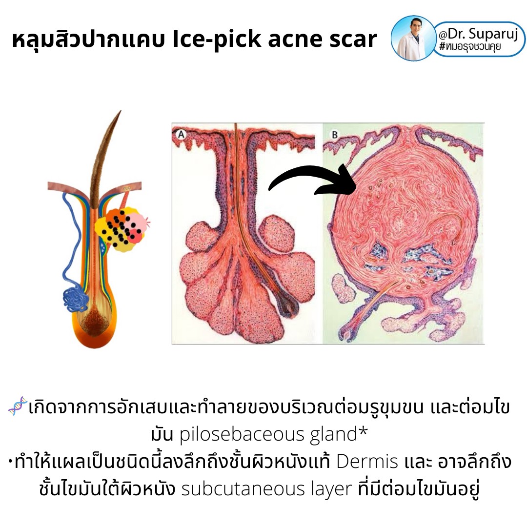  แนะนำเทคนิครักษาหลุมสิวจิกลึก Ice Pick Acne Scar ด้วยเทคนิคเลเซอร์ UltraDeep Pico Technique (Ice Pick Acne Scar Treatment with Discovery Pico Laser + UltraDeep Pico Technique)