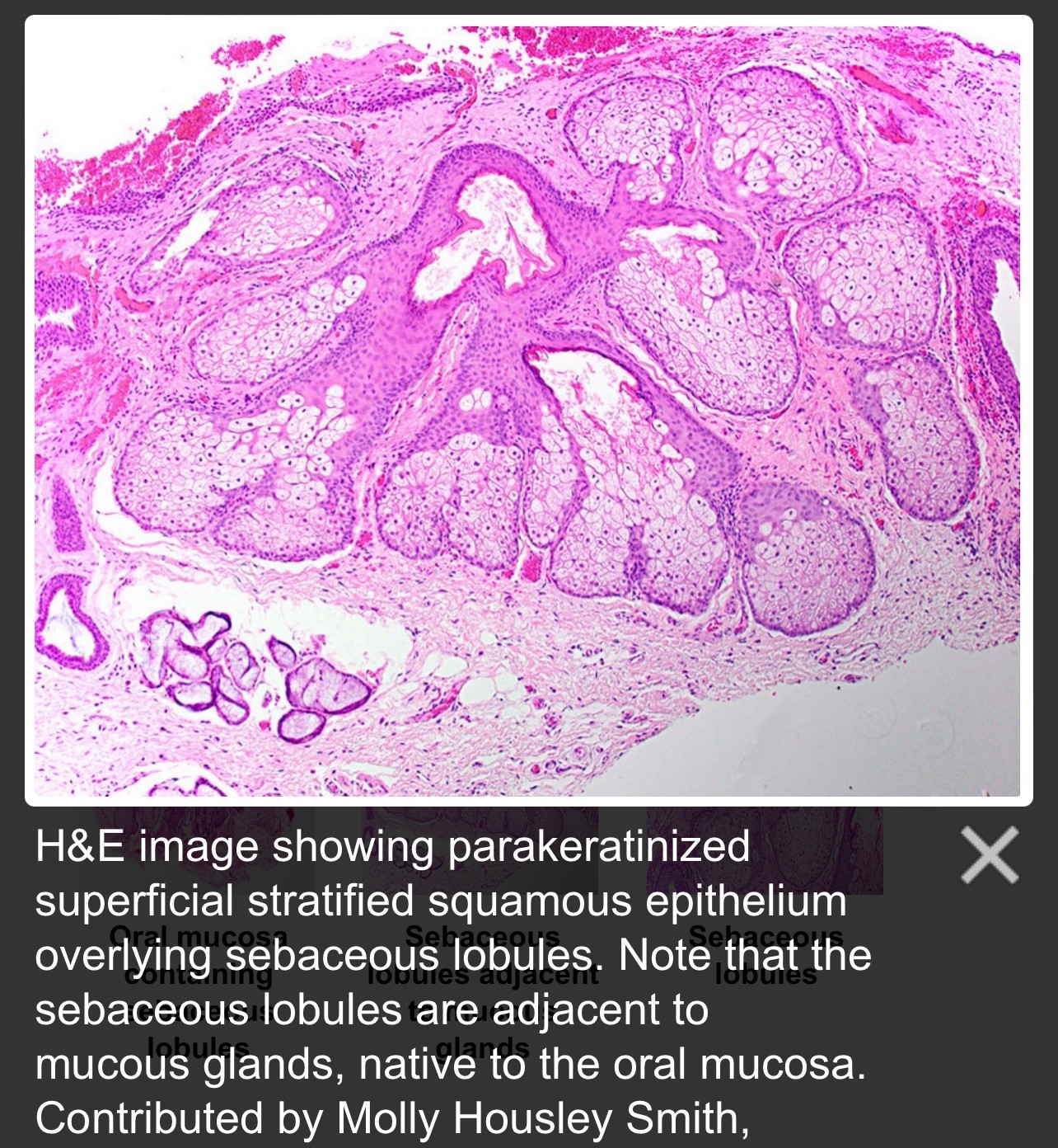 Fordyce Spot ตุ่มไขมันที่ริมฝีปาก คืออะไร มีลักษณะอย่างไร & มีวิธีดูแลได้อย่างไรบ้าง? Fordyce Spot ตุ่มไขมันที่ริมฝีปาก คืออะไร มีลักษณะอย่างไร & มีวิธีดูแลได้อย่างไรบ้าง?