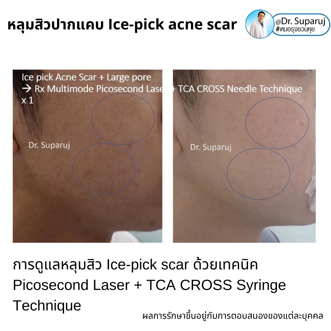 แนะนำเทคนิครักษาหลุมสิวจิกลึก Ice Pick Acne Scar ด้วยเทคนิคเลเซอร์ UltraDeep Pico Technique (Ice Pick Acne Scar Treatment with Discovery Pico Laser + UltraDeep Pico Technique)  แนะนำเทคนิครักษาหลุมสิวจิกลึก Ice Pick Acne Scar ด้วยเทคนิคเลเซอร์ UltraDeep Pico Technique (Ice Pick Acne Scar Treatment with Discovery Pico Laser + UltraDeep Pico Technique)