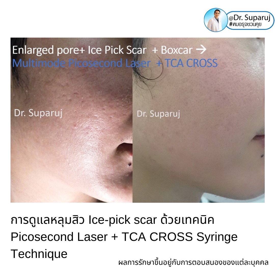  แนะนำเทคนิครักษาหลุมสิวจิกลึก Ice Pick Acne Scar ด้วยเทคนิคเลเซอร์ UltraDeep Pico Technique (Ice Pick Acne Scar Treatment with Discovery Pico Laser + UltraDeep Pico Technique)