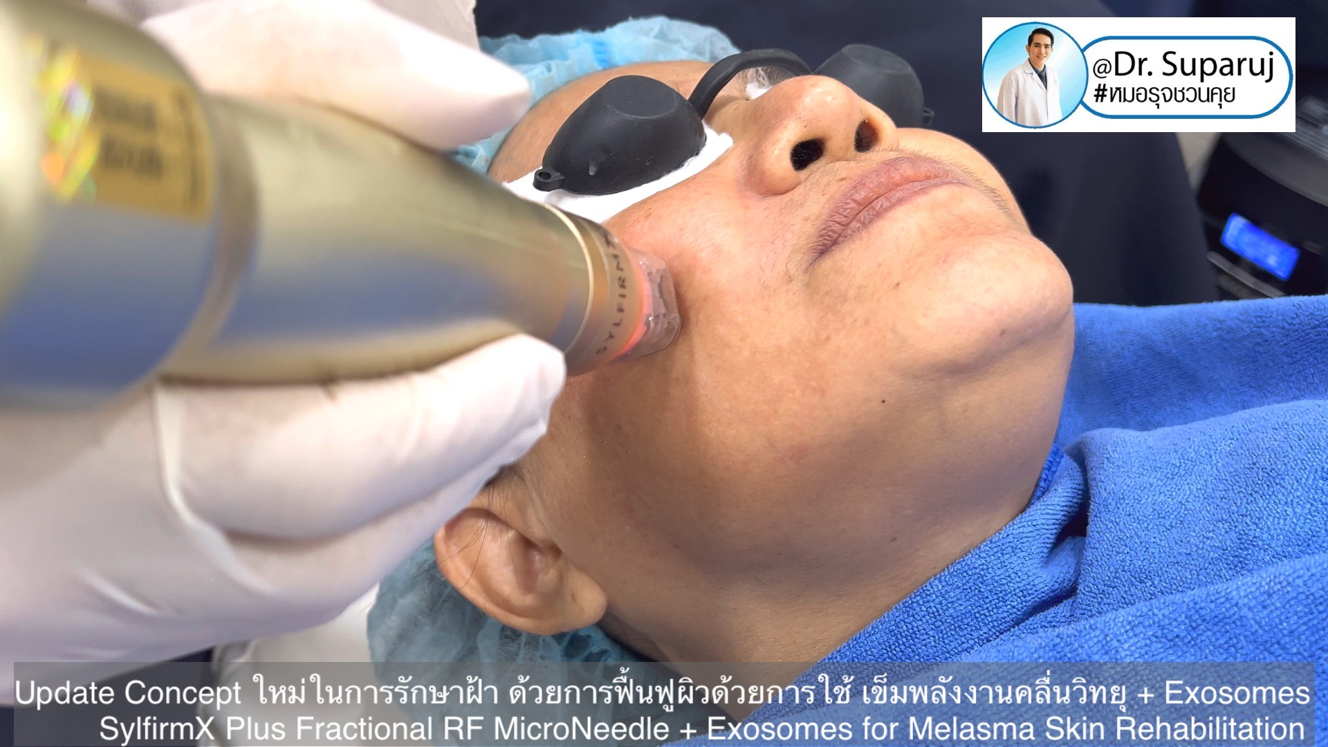Update Concept ใหม่ในการรักษาฝ้า ด้วยการฟื้นฟูผิวด้วยการใช้ เข็มพลังงานคลื่นวิทยุ + Exosomes (SylfirmX Plus Fractional RF MicroNeedle + Exosomes for Melasma Skin Rehabilitation) Update Concept ใหม่ในการรักษาฝ้า ด้วยการฟื้นฟูผิวด้วยการใช้ เข็มพลังงานคลื่นวิทยุ + Exosomes (SylfirmX Plus Fractional RF MicroNeedle + Exosomes for Melasma Skin Rehabilitation)