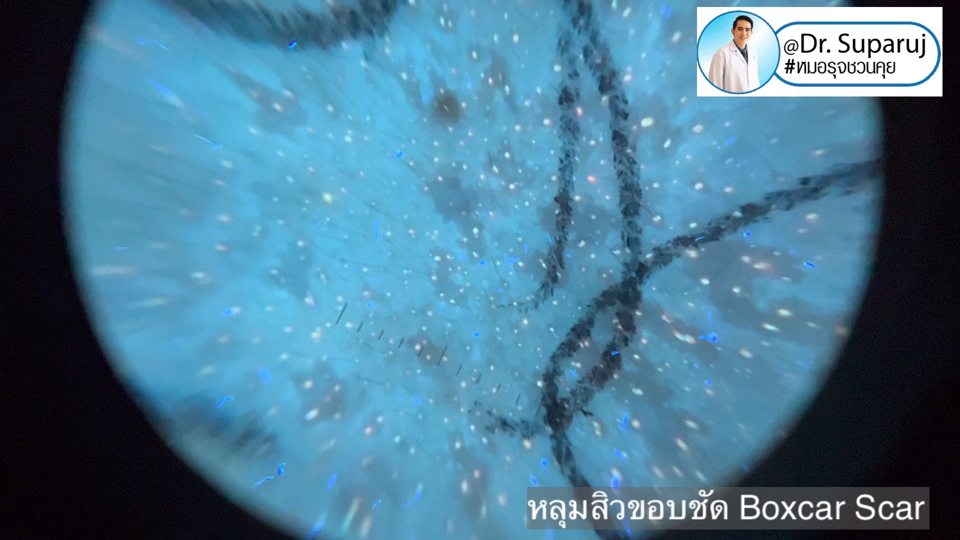 Back to the Basics: หลุมสิวมีกี่ชนิด & มีลักษณะอย่างไร ? Acne Scar Classification Full Clip คลิปเต็ม Facebook/ YouTube Dr. Suparuj หมอรุจชวนคุย ครับ Back to the Basics: หลุมสิวมีกี่ชนิด & มีลักษณะอย่างไร ? Acne Scar Classification Full Clip คลิปเต็ม Facebook/ YouTube Dr. Suparuj หมอรุจชวนคุย ครับ