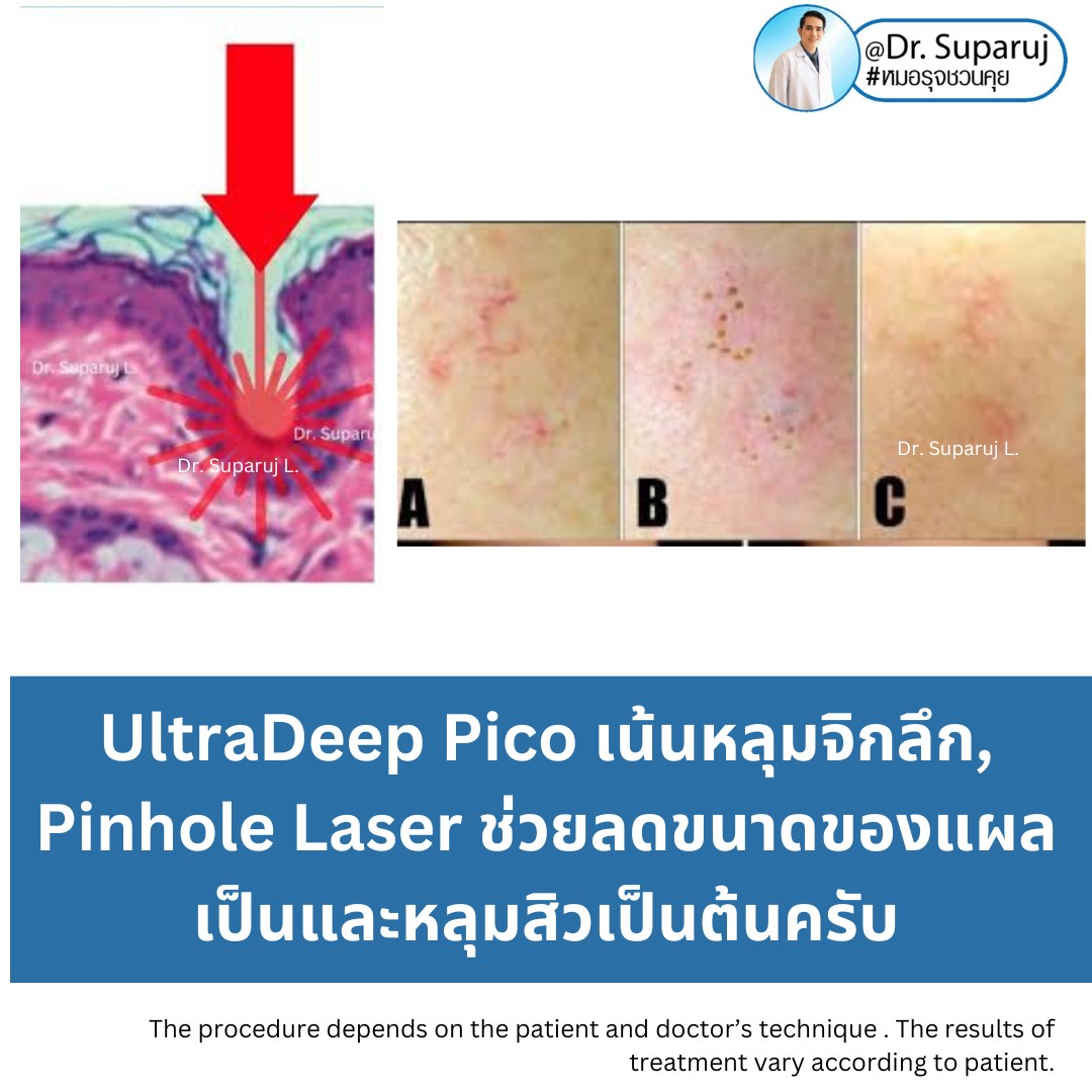 เทคนิคโปรแกรมรักษาหลุมสิว ที่หมอใช้บ่อยครับ เทคนิคโปรแกรมรักษาหลุมสิว ที่หมอใช้บ่อยครับ