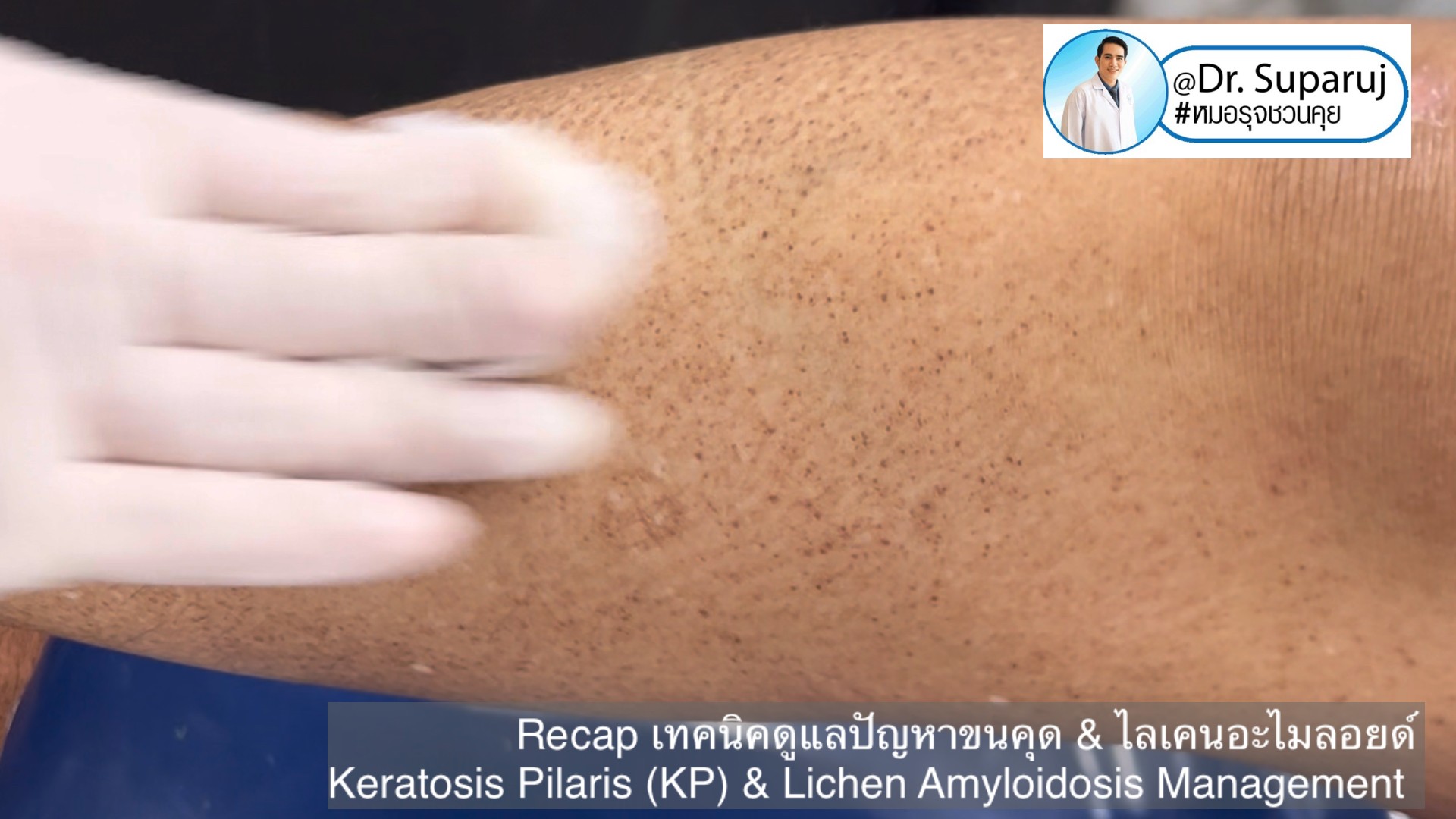 Recap เทคนิคดูแลปัญหาขนคุด & ไลเคนอะไมลอยด์  Keratosis Pilaris (KP) & Lichen Amyloidosis Management