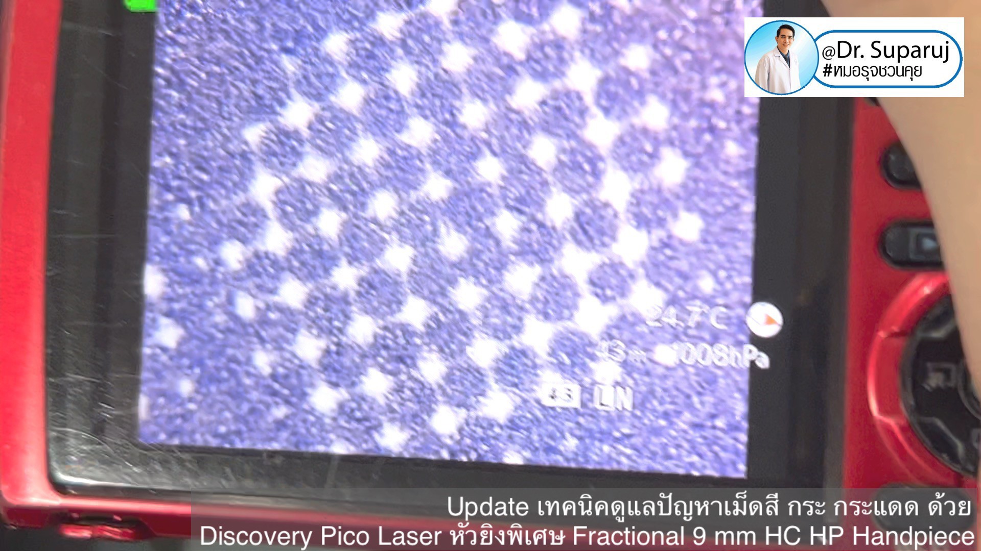 แนะนำเทคนิคดูแลปานน้ำตาล ด้วยเลเซอร์เทคนิค Fractional Pigment Toning FPT Discovery Picosecond Laser + Fractional 9 mm HC HP Handpiece แนะนำเทคนิคดูแลปานน้ำตาล ด้วยเลเซอร์เทคนิค Fractional Pigment Toning FPT Discovery Picosecond Laser + Fractional 9 mm HC HP Handpiece