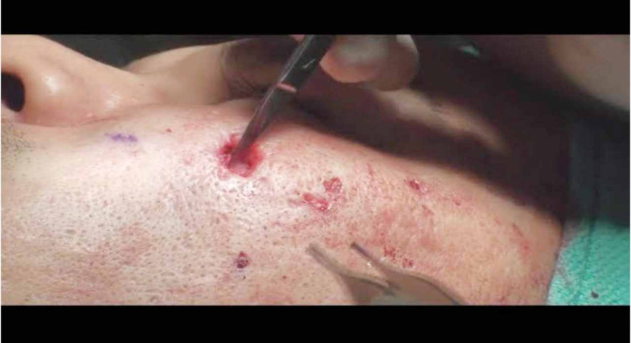 แผลเป็นจากสิวที่มีลักษณะสีขาว severe fibrotic acne scar เกิดจากอะไร & ดูแลได้อย่างไร ? แผลเป็นจากสิวที่มีลักษณะสีขาว severe fibrotic acne scar เกิดจากอะไร & ดูแลได้อย่างไร ?