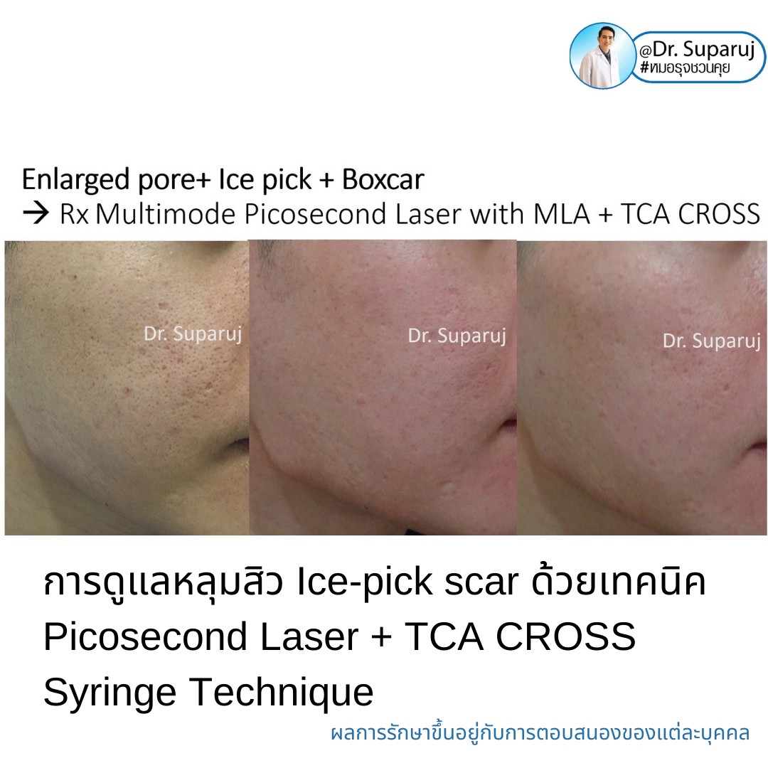 แนะนำเทคนิครักษาหลุมสิวจิกลึก Ice Pick Acne Scar ด้วยเทคนิคเลเซอร์ UltraDeep Pico Technique (Ice Pick Acne Scar Treatment with Discovery Pico Laser + UltraDeep Pico Technique)  แนะนำเทคนิครักษาหลุมสิวจิกลึก Ice Pick Acne Scar ด้วยเทคนิคเลเซอร์ UltraDeep Pico Technique (Ice Pick Acne Scar Treatment with Discovery Pico Laser + UltraDeep Pico Technique)