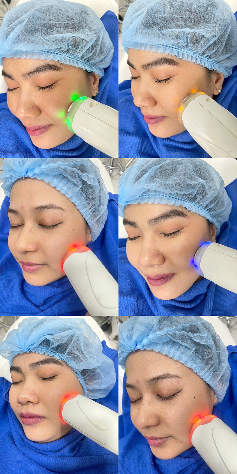 โปรแกรม PORA COOL + Skin Radiant Treatment โพล่าร์คูล + สกินเรเดียน ทรีทเมนท์ หน้ากระจ่างใส ลดการอักเสบของผิว ลดสิว