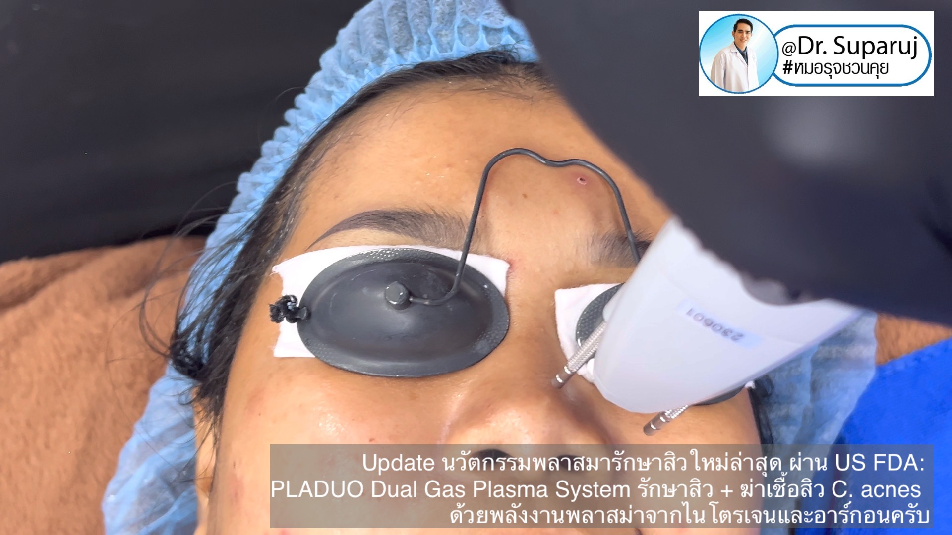 Update นวัตกรรมพลาสมารักษาสิวใหม่ล่าสุด ผ่าน US FDA: PLADUO Dual Gas Plasma System ช่วยรักษาสิว + ฆ่าเชื้อสิว C. acnes + รักษาหลุมสิว รอยดำ รอยแดง