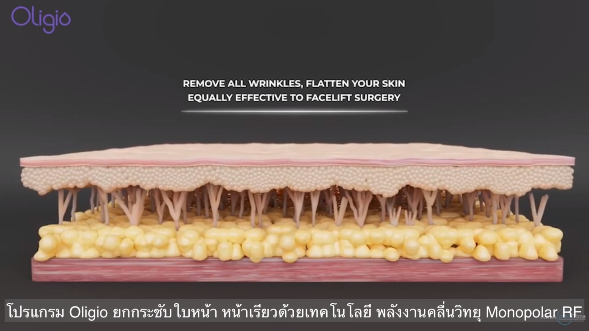 ยกกระชับผิวหน้าด้วย โปรแกรม Oligio Monopolar RF มีกลไก& จุดเด่น อย่างไร ? ยกกระชับผิวหน้าด้วย โปรแกรม Oligio Monopolar RF มีกลไก& จุดเด่น อย่างไร ?