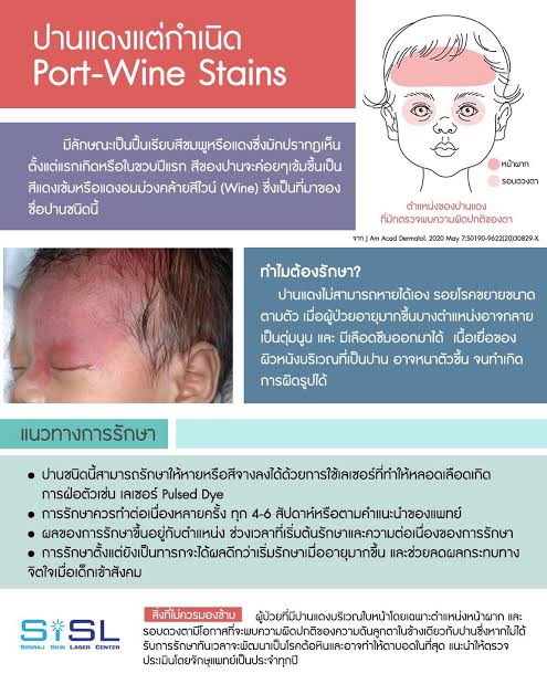 เทคนิคดูแลปานแต่กำเนิดด้วยเลเซอร์ดิสคัฟเวอรี่พิโค Birthmark Treatment with Special Handpieces of Discovery Pico Laser เทคนิคดูแลปานแต่กำเนิดด้วยเลเซอร์ดิสคัฟเวอรี่พิโค Birthmark Treatment with Special Handpieces of Discovery Pico Laser