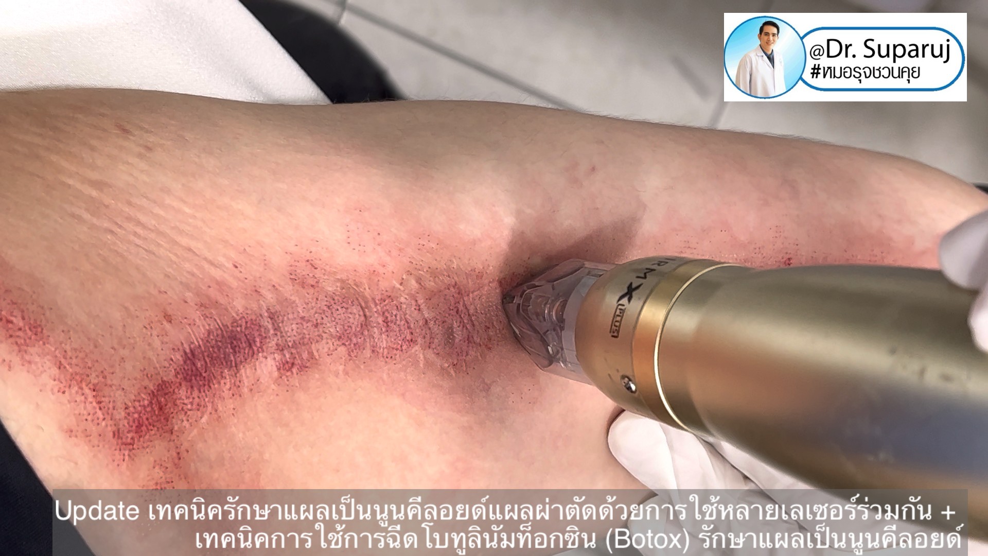 Update เทคนิครักษาแผลเป็นนูนคีลอยด์แผลผ่าตัดด้วยการใช้หลายเลเซอร์ร่วมกัน + เทคนิคการใช้การฉีดโบทูลินัมท็อกซิน (Botox) รักษาแผลเป็นนูนคีลอยด์ Update เทคนิครักษาแผลเป็นนูนคีลอยด์แผลผ่าตัดด้วยการใช้หลายเลเซอร์ร่วมกัน + เทคนิคการใช้การฉีดโบทูลินัมท็อกซิน (Botox) รักษาแผลเป็นนูนคีลอยด์