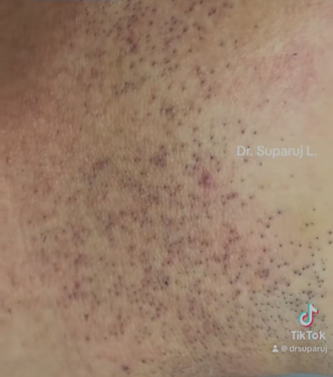 ขนคุดที่มีสีแดง KP Rubra มีลักษณะอย่างไร & ดูแลได้อย่างไร?  ขนคุดที่มีสีแดง KP Rubra มีลักษณะอย่างไร & ดูแลได้อย่างไร?