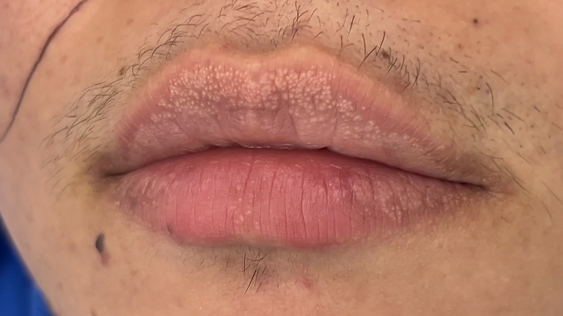 Fordyce Spot ตุ่มไขมันที่ริมฝีปาก คืออะไร มีลักษณะอย่างไร & มีวิธีดูแลได้อย่างไรบ้าง? Fordyce Spot ตุ่มไขมันที่ริมฝีปาก คืออะไร มีลักษณะอย่างไร & มีวิธีดูแลได้อย่างไรบ้าง?