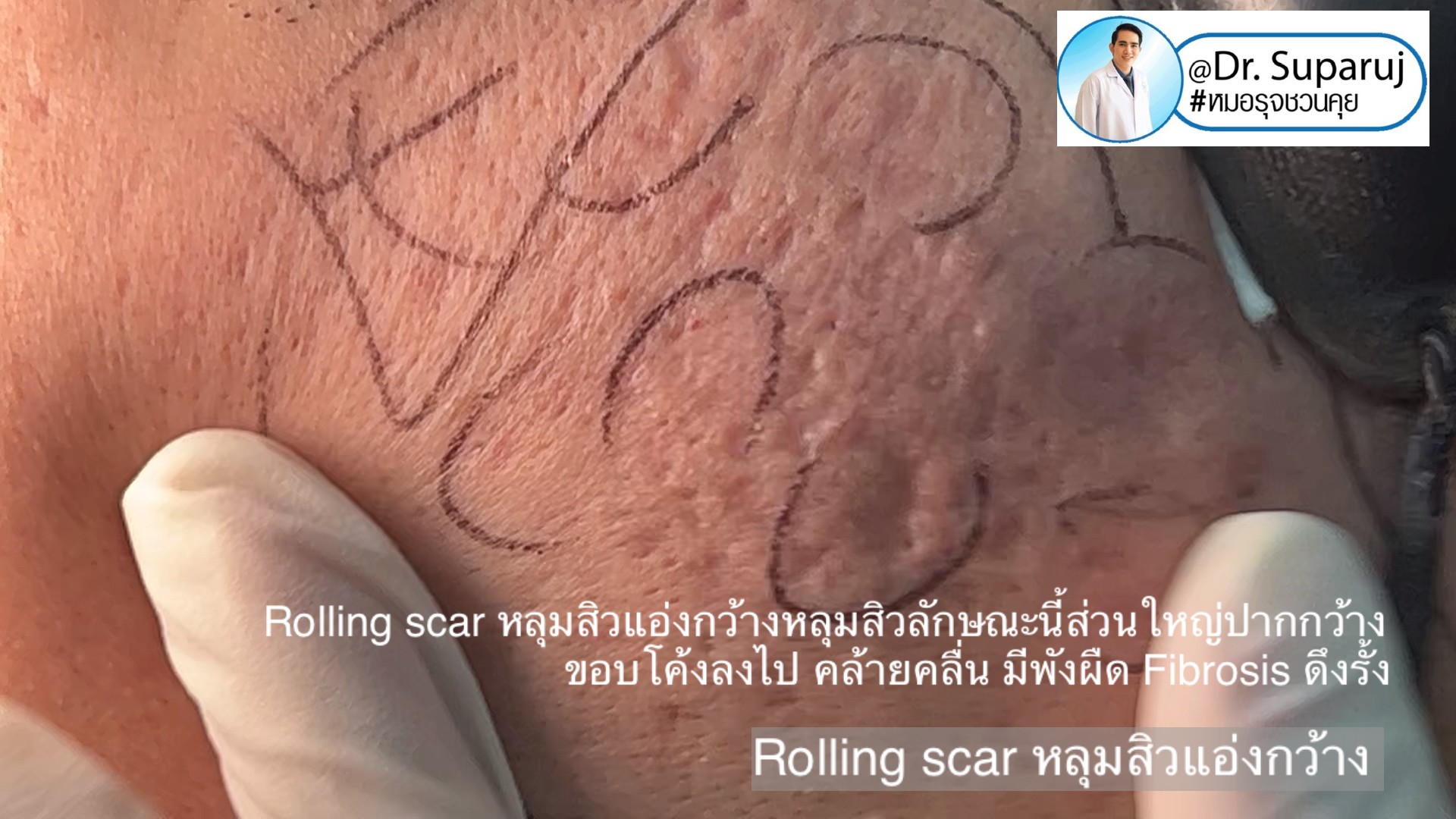 Back to the Basics: หลุมสิวมีกี่ชนิด & มีลักษณะอย่างไร ? Acne Scar Classification Full Clip คลิปเต็ม Facebook/ YouTube Dr. Suparuj หมอรุจชวนคุย ครับ Back to the Basics: หลุมสิวมีกี่ชนิด & มีลักษณะอย่างไร ? Acne Scar Classification Full Clip คลิปเต็ม Facebook/ YouTube Dr. Suparuj หมอรุจชวนคุย ครับ