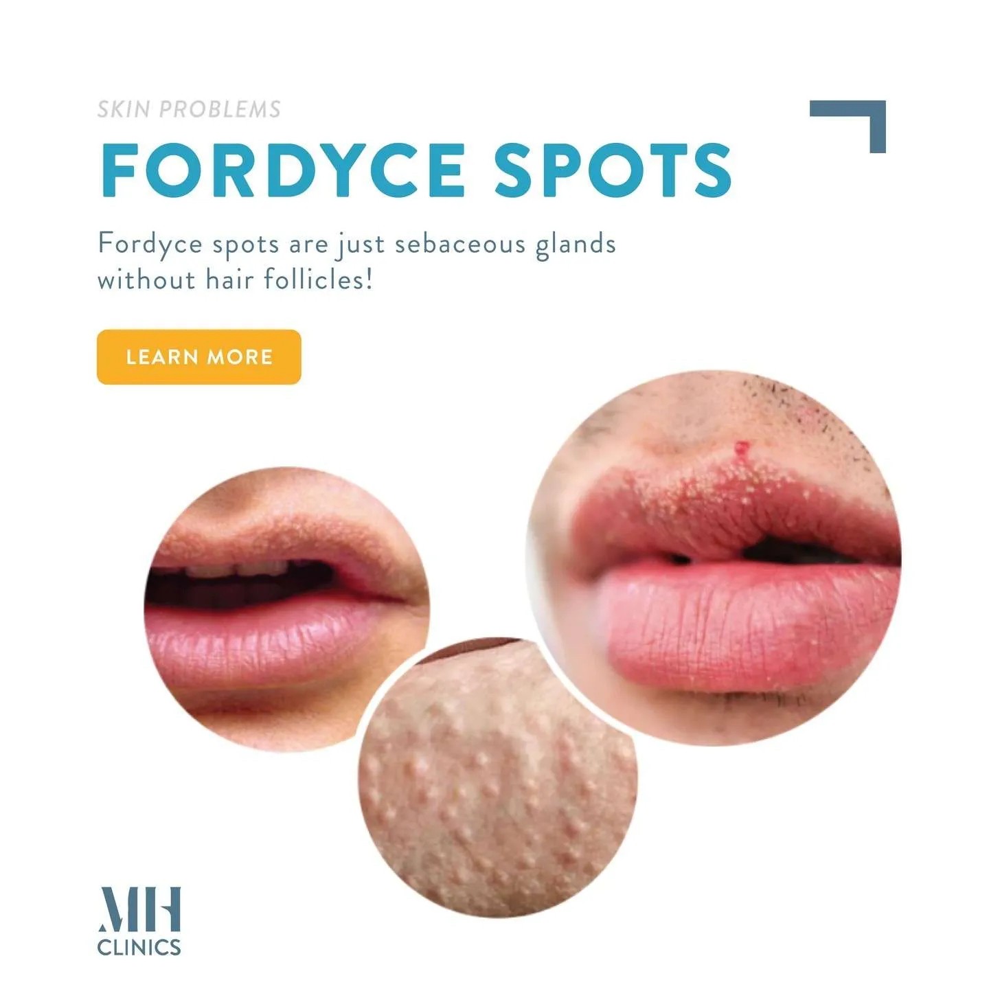 Fordyce Spot ตุ่มไขมันที่ริมฝีปาก คืออะไร มีลักษณะอย่างไร & มีวิธีดูแลได้อย่างไรบ้าง? Fordyce Spot ตุ่มไขมันที่ริมฝีปาก คืออะไร มีลักษณะอย่างไร & มีวิธีดูแลได้อย่างไรบ้าง?