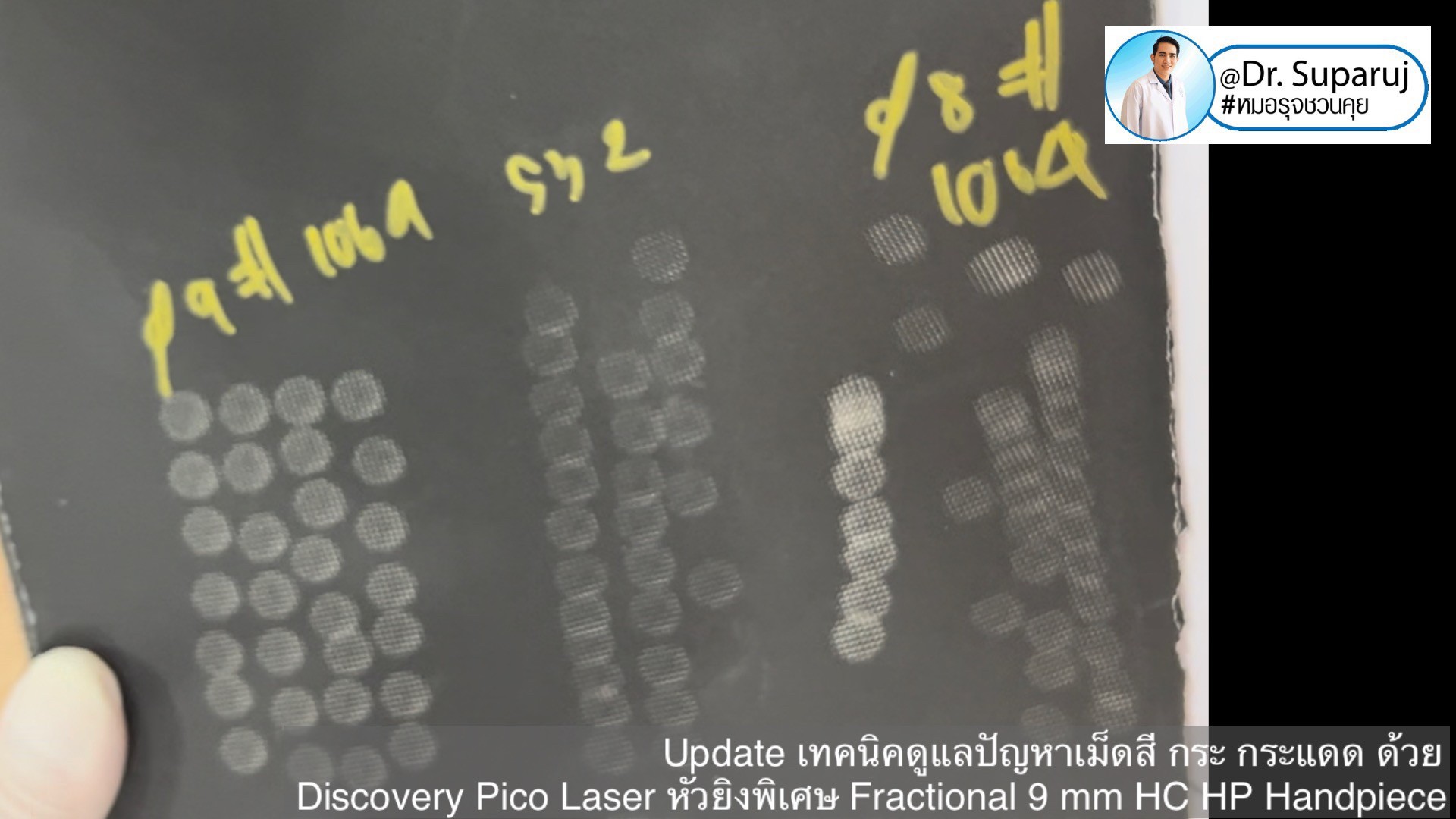 แนะนำเทคนิคดูแลปานน้ำตาล ด้วยเลเซอร์เทคนิค Fractional Pigment Toning FPT Discovery Picosecond Laser + Fractional 9 mm HC HP Handpiece แนะนำเทคนิคดูแลปานน้ำตาล ด้วยเลเซอร์เทคนิค Fractional Pigment Toning FPT Discovery Picosecond Laser + Fractional 9 mm HC HP Handpiece