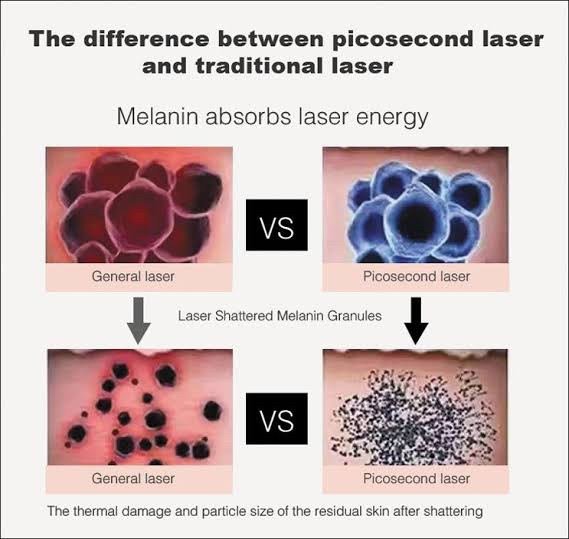แนะนำเทคนิคเลเซอร์ลบรอยสักด้วย Picosecond Laser: ลบรอยสักด้วยเลเซอร์ Discovery Picosecond Laser มีเทคนิคอย่างไร ? แนะนำเทคนิคเลเซอร์ลบรอยสักด้วย Picosecond Laser: ลบรอยสักด้วยเลเซอร์ Discovery Picosecond Laser มีเทคนิคอย่างไร ?