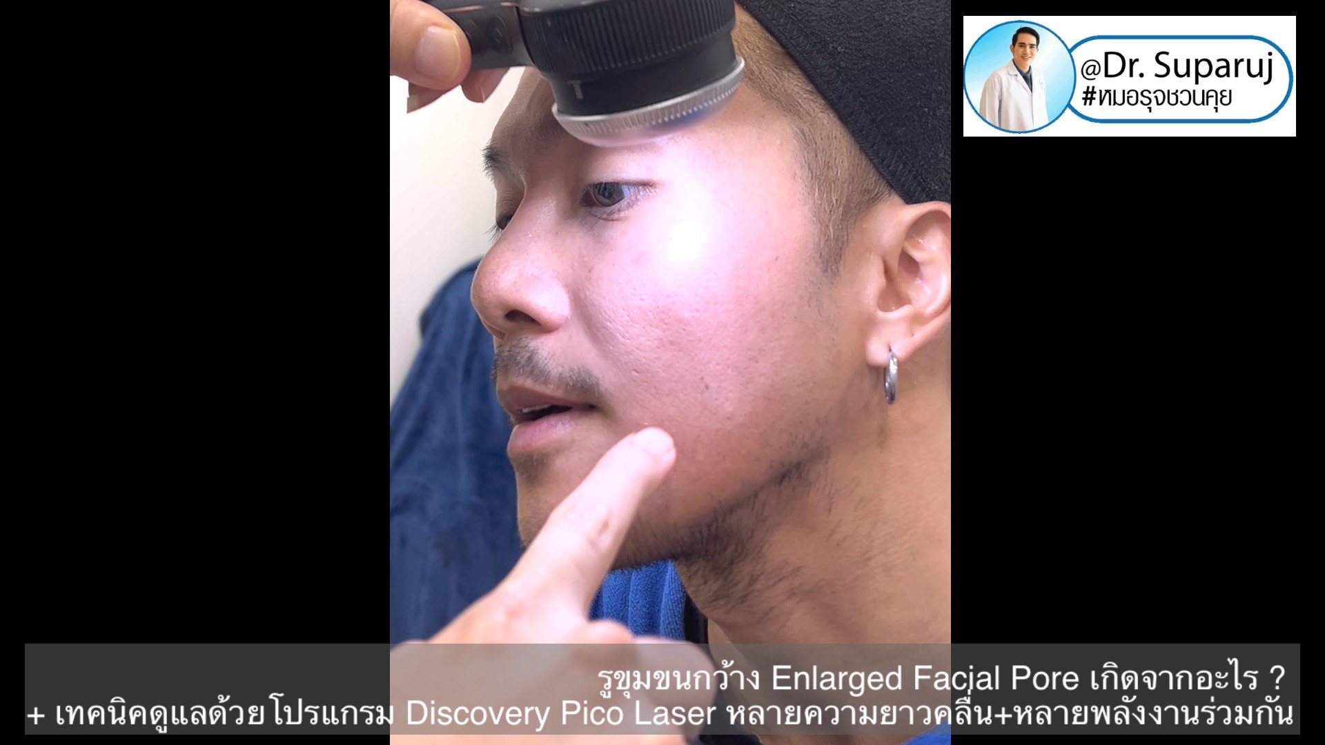 รูขุมขนกว้าง Enlarged Facial Pore เกิดจากอะไร ? + เทคนิคดูแลด้วยโปรแกรม Discovery Pico Laser หลายความยาวคลื่น +หลายพลังงานร่วมกัน