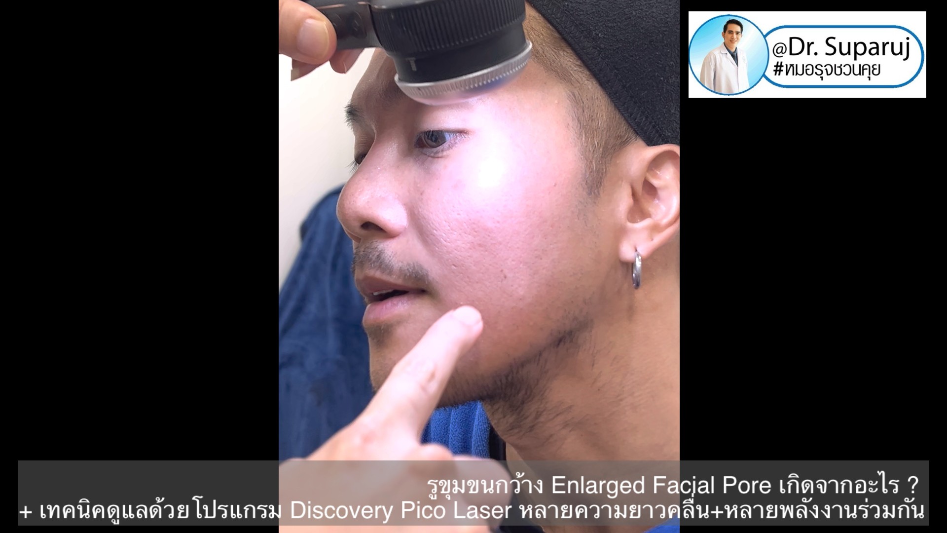 รูขุมขนกว้าง Enlarged Facial Pore เกิดจากอะไร ? + เทคนิคดูแลด้วยโปรแกรม Discovery Pico Laser หลายความยาวคลื่น +หลายพลังงานร่วมกัน รูขุมขนกว้าง Enlarged Facial Pore เกิดจากอะไร ? + เทคนิคดูแลด้วยโปรแกรม Discovery Pico Laser หลายความยาวคลื่น +หลายพลังงานร่วมกัน