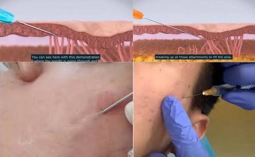 Update เทคนิค Subcision ตัดพังผืดรักษาหลุมสิว Acne Scar Subcision Techniques