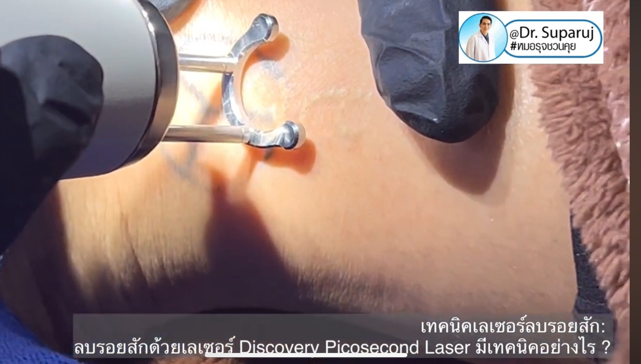 ทำไมต้องลบรอยสักด้วย พิโค่เลเซอร์ Picosecond Laser ทำไมต้องลบรอยสักด้วย พิโค่เลเซอร์ Picosecond Laser