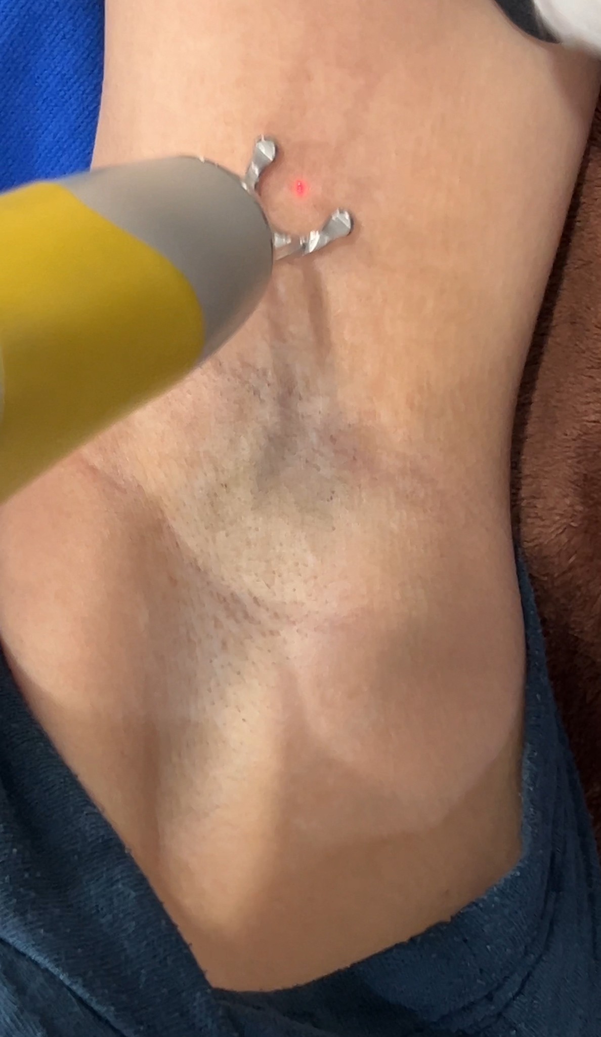 รักแร้ดำเกิดจากสาเหตุอะไร & ดูแลอย่างไร ? รักแร้ดำเกิดจากสาเหตุอะไร & ดูแลอย่างไร ?