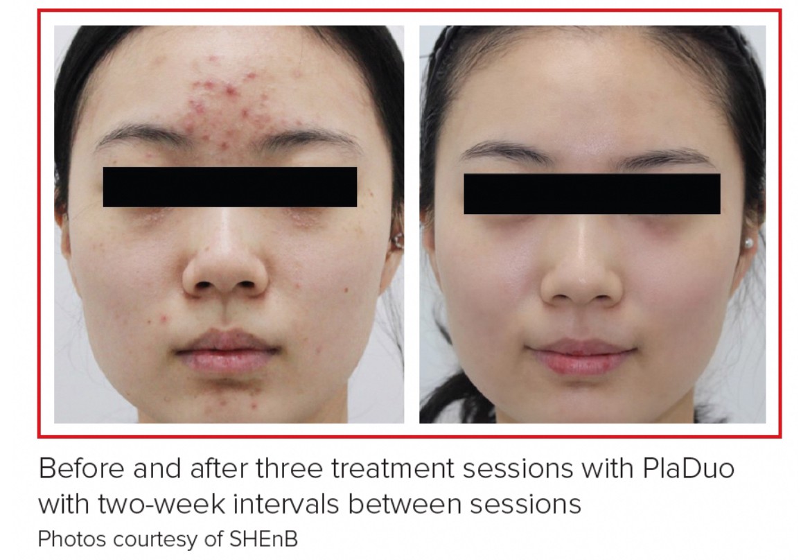 Update นวัตกรรมพลาสมารักษาสิวใหม่ล่าสุด ผ่าน US FDA: PLADUO Dual Gas Plasma System ช่วยรักษาสิว + ฆ่าเชื้อสิว C. acnes + รักษาหลุมสิว รอยดำ รอยแดง Update นวัตกรรมพลาสมารักษาสิวใหม่ล่าสุด ผ่าน US FDA: PLADUO Dual Gas Plasma System ช่วยรักษาสิว + ฆ่าเชื้อสิว C. acnes + รักษาหลุมสิว รอยดำ รอยแดง