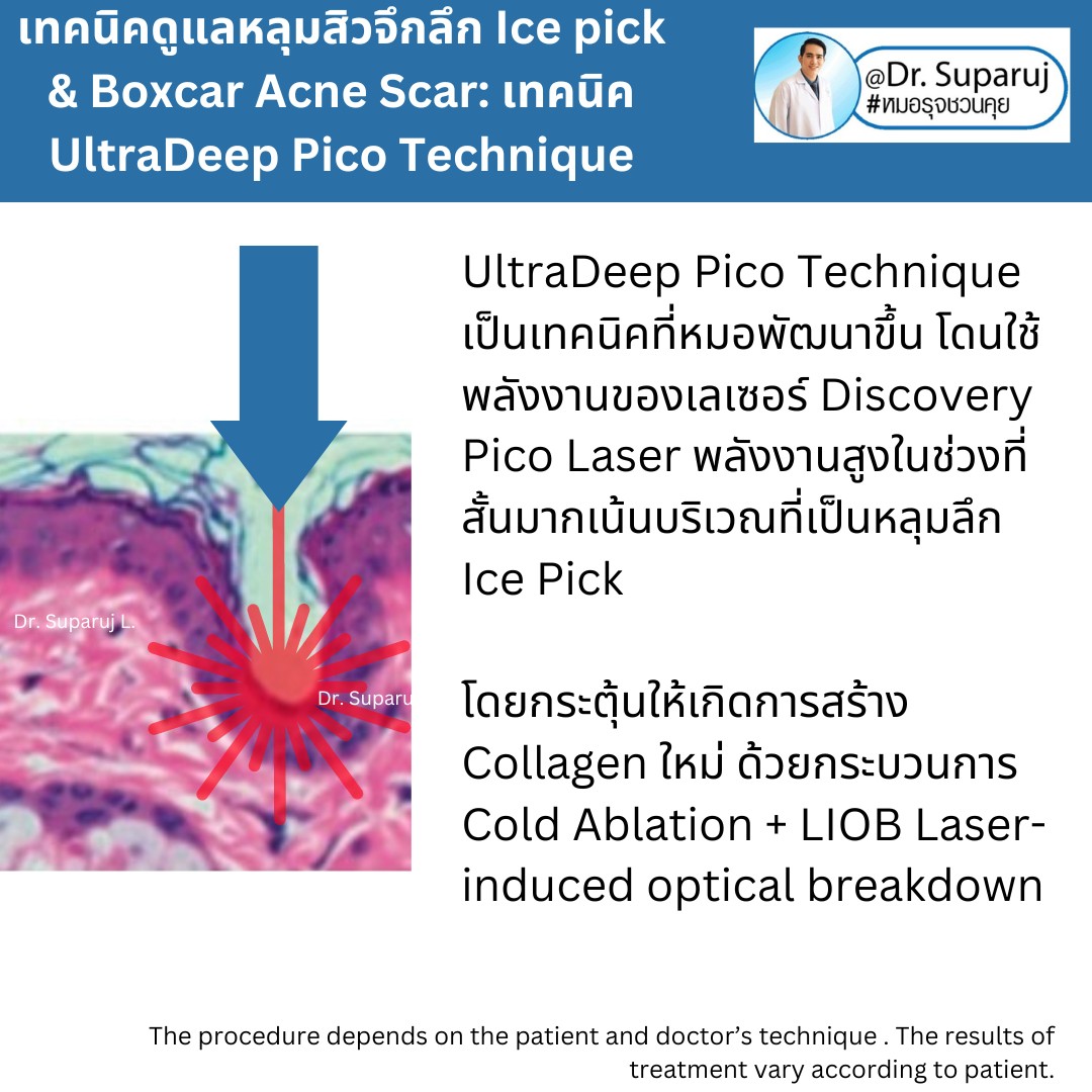 แนะนำเทคนิครักษาหลุมสิวจิกลึก Ice Pick Acne Scar ด้วยเทคนิคเลเซอร์ UltraDeep Pico Technique (Ice Pick Acne Scar Treatment with Discovery Pico Laser + UltraDeep Pico Technique)  แนะนำเทคนิครักษาหลุมสิวจิกลึก Ice Pick Acne Scar ด้วยเทคนิคเลเซอร์ UltraDeep Pico Technique (Ice Pick Acne Scar Treatment with Discovery Pico Laser + UltraDeep Pico Technique)