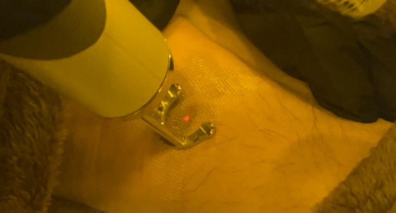 เทคนิคดูแลปานแต่กำเนิดด้วยเลเซอร์ดิสคัฟเวอรี่พิโค Birthmark Treatment with Special Handpieces of Discovery Pico Laser