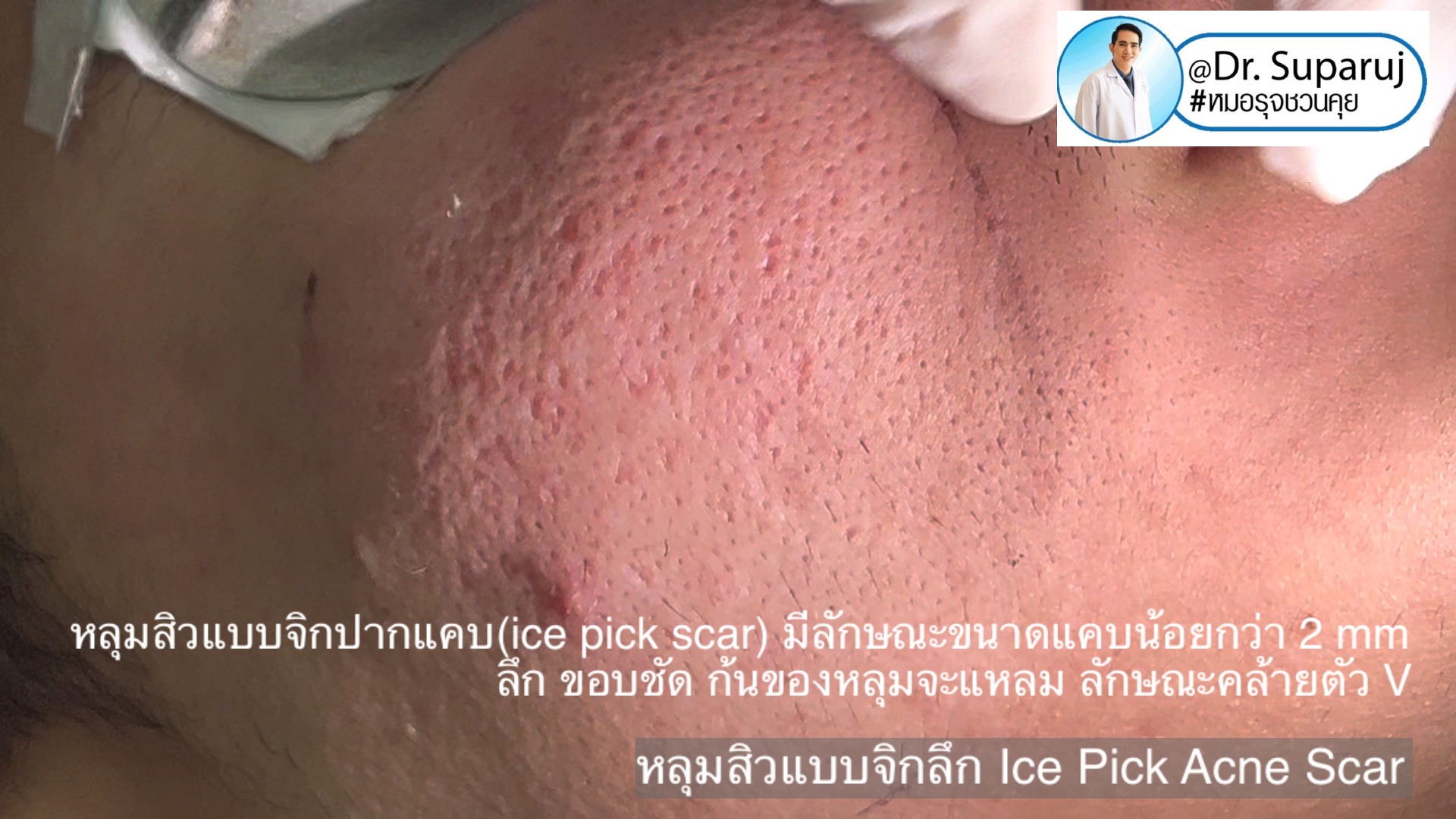 Back to the Basics: หลุมสิวมีกี่ชนิด & มีลักษณะอย่างไร ? Acne Scar Classification Full Clip คลิปเต็ม Facebook/ YouTube Dr. Suparuj หมอรุจชวนคุย ครับ Back to the Basics: หลุมสิวมีกี่ชนิด & มีลักษณะอย่างไร ? Acne Scar Classification Full Clip คลิปเต็ม Facebook/ YouTube Dr. Suparuj หมอรุจชวนคุย ครับ