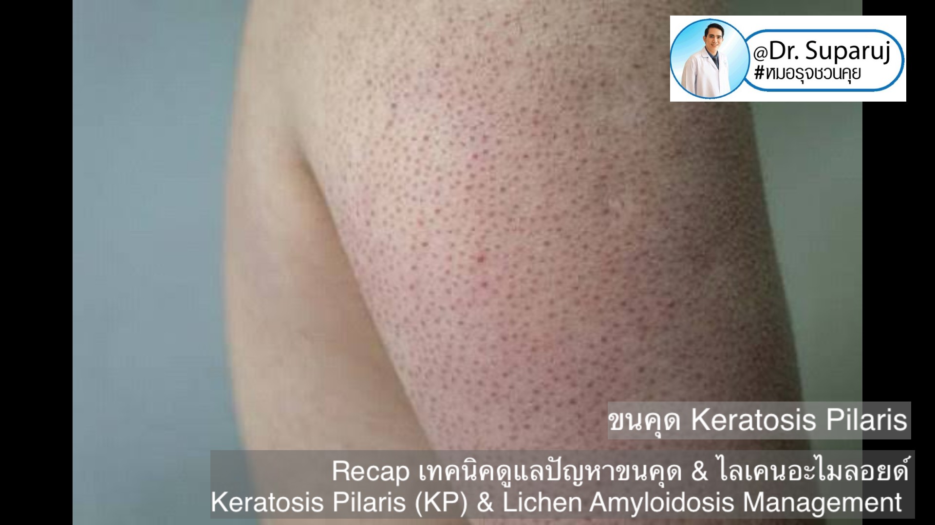 Recap เทคนิคดูแลปัญหาขนคุด & ไลเคนอะไมลอยด์  Keratosis Pilaris (KP) & Lichen Amyloidosis Management