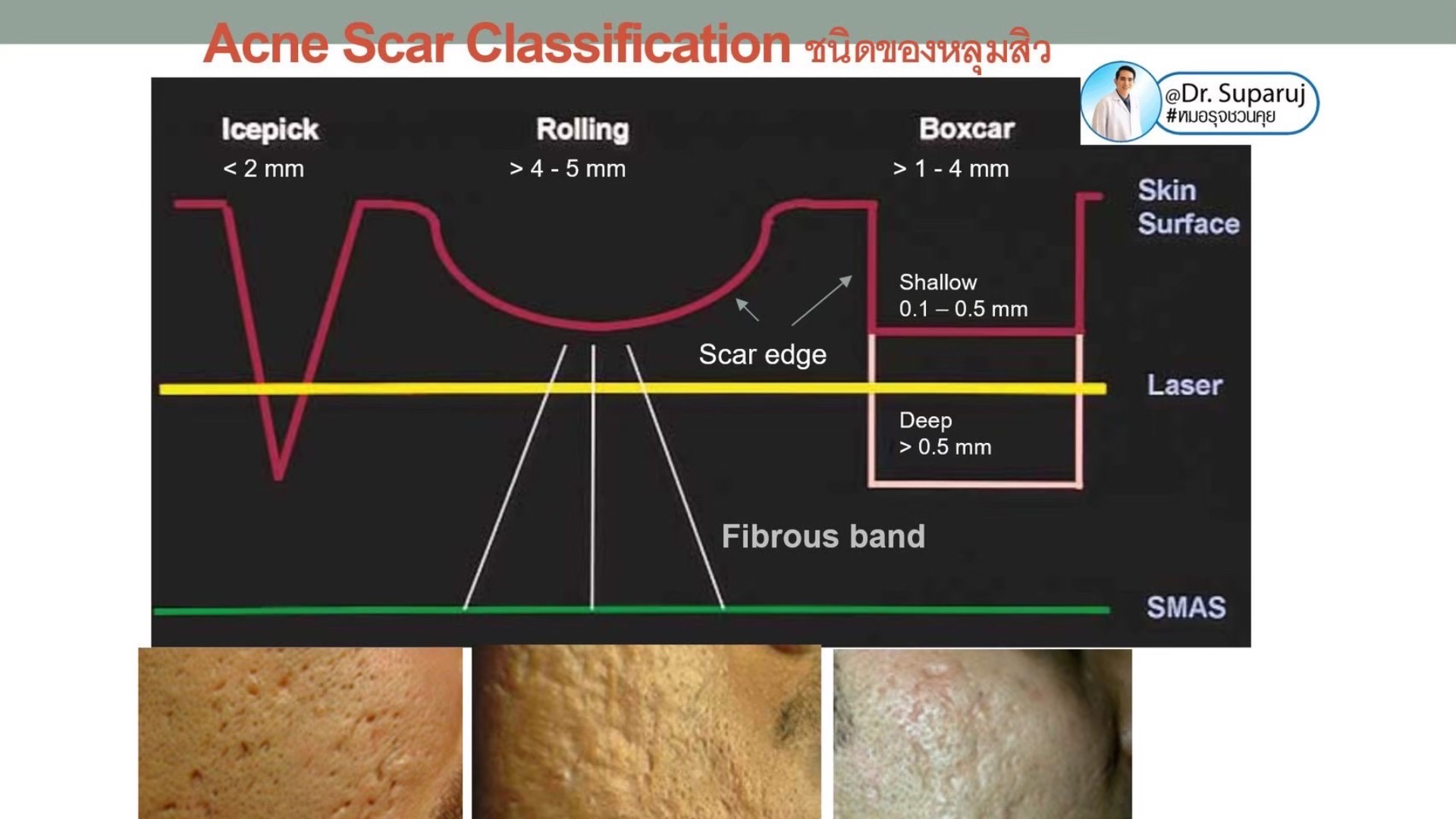 Back to the Basics: หลุมสิวมีกี่ชนิด & มีลักษณะอย่างไร ? Acne Scar Classification Full Clip คลิปเต็ม Facebook/ YouTube Dr. Suparuj หมอรุจชวนคุย ครับ Back to the Basics: หลุมสิวมีกี่ชนิด & มีลักษณะอย่างไร ? Acne Scar Classification Full Clip คลิปเต็ม Facebook/ YouTube Dr. Suparuj หมอรุจชวนคุย ครับ
